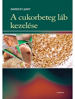 A cukorbeteg láb kezelése