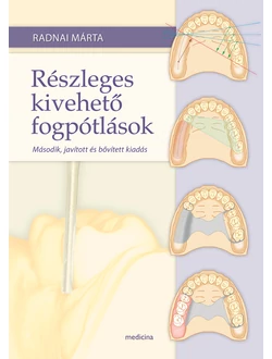 Részleges kivehető fogpótlások