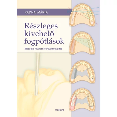 Részleges kivehető fogpótlások