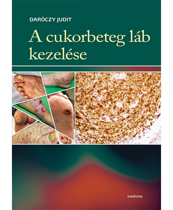 A cukorbeteg láb kezelése