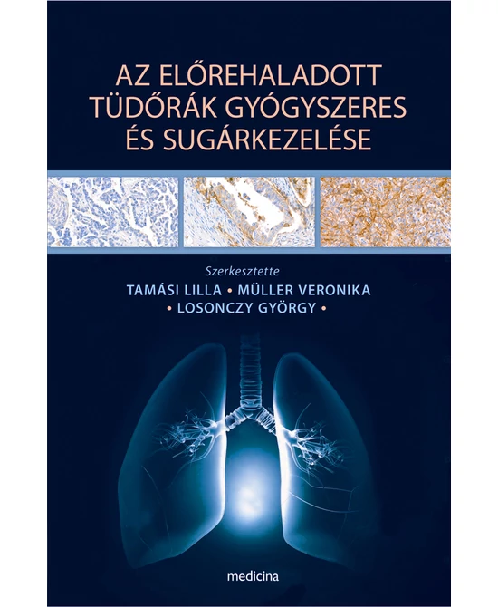 Az előrehaladott tüdőrák gyógyszeres és sugárkezelése