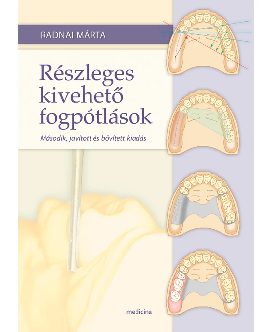 Részleges kivehető fogpótlások