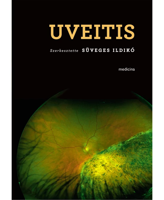 Uveitis