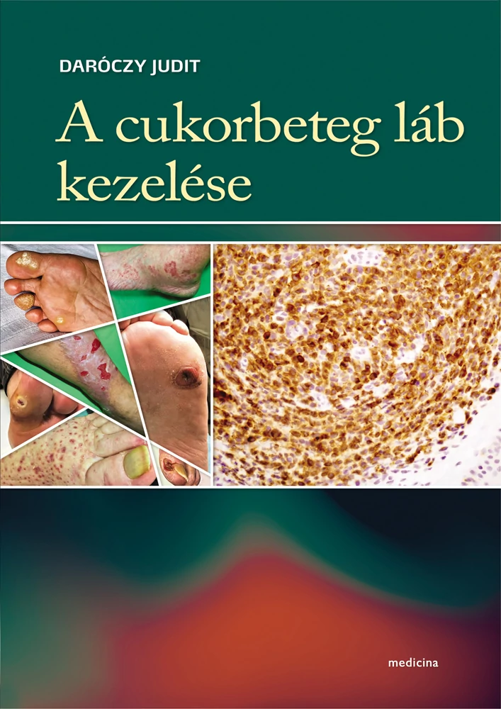 A cukorbeteg láb kezelése