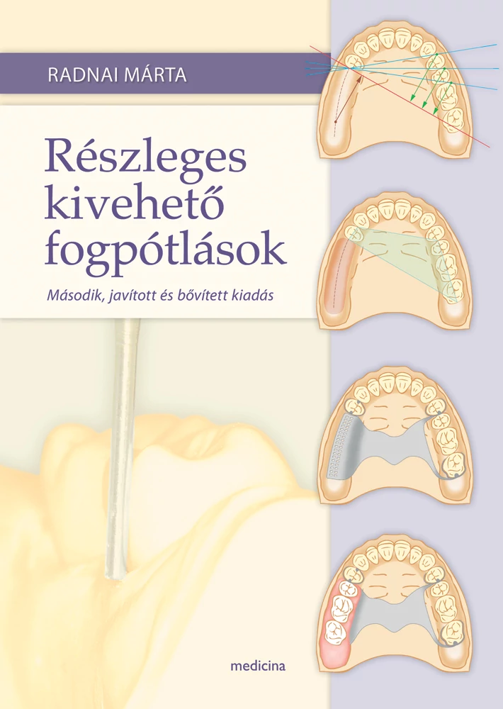 Részleges kivehető fogpótlások