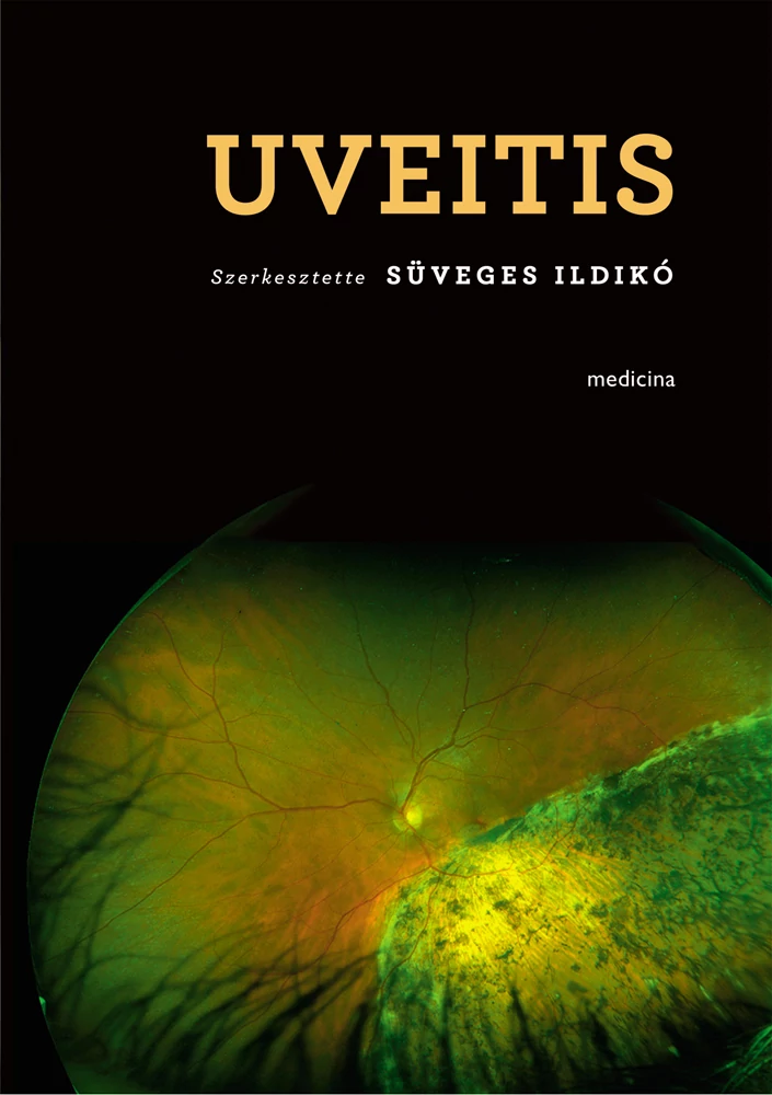 Uveitis